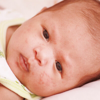 8 first-line treatments for atopic dermatitis in infants