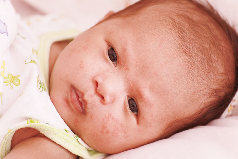 8 first-line treatments for atopic dermatitis in infants