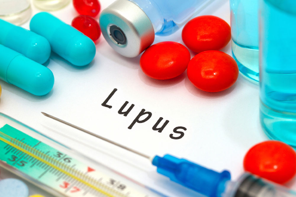 Avoid These 12 Triggers to Manage Lupus