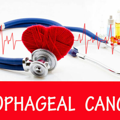 Esophageal cancer &#8211; Signs, causes, and management