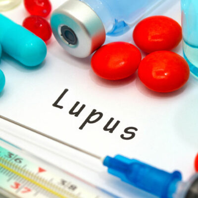 Lupus &#8211; Symptoms, Risk Factors, and Diagnosis